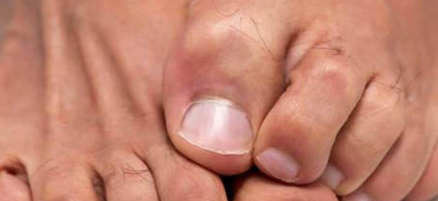 Как лечить грибок на ногтях ног народными средствами