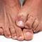 Как лечить грибок на ногтях ног народными средствами