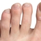 Можно ли вылечить грибок ногтей на ногах уксусом