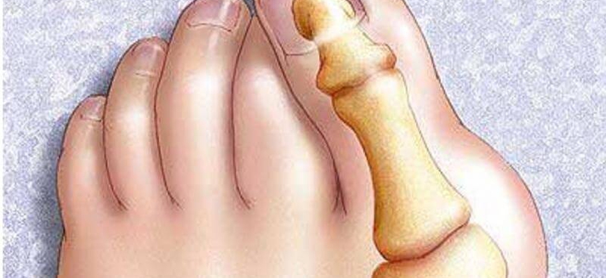 Растущая косточка на большом пальце ноги и как ее лечить
